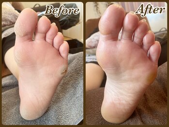 ビューティースパ(Beauty-Spa)/【タコ・ウオノメの角質除去】