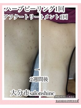 サロンシャイン(Salon Shine)/ハーブピーリング1回ハード