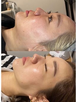 アプロディタ/クリニック並！肌管理は当店で