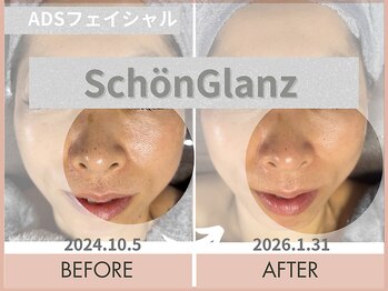シェーングランツ(SchonGlanz)/フェイシャルで肌質改善