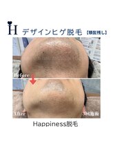ハピネス 広島並木通り店(Happiness)/デザインヒゲ脱毛