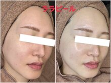ちゅるん肌ドットコム 梅田店(ちゅるん肌.com)の雰囲気（女優肌を叶えるララピール♪毛穴・くすみ・ニキビでお悩みの方に）