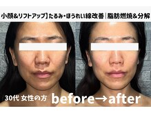 サロンスペース/30代 女性【小顔&リフトアップ】