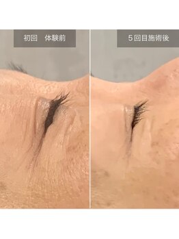 ケイ(Kei)/肌質改善コースbefore/after　　