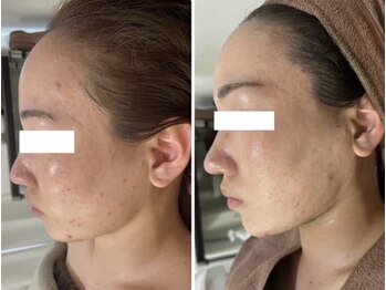 ホワイトアクア 岐阜店(WHITE AQUA)/ハーブピーリング/岐阜/ニキビ