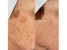 温(on)/プロセルセラピーズフェイシャル