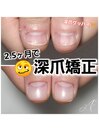 深爪矯正☆