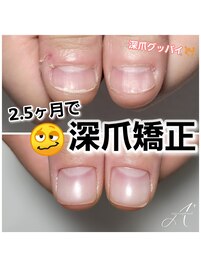 深爪矯正☆