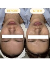 ハウピア(Haupia)/◇小顔Vリフト◇