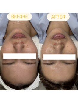 ハウピア(Haupia)/◇小顔Vリフト◇