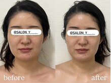サロンワイアネシス(Salon y ANESIS)/小顔コルギ1回の変化