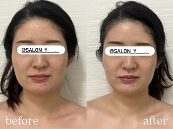 サロンワイアネシス(Salon y ANESIS)/小顔コルギ1回の変化