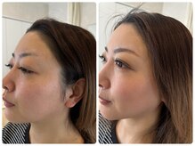 アンベリール(EMBELLIR)/ご新規限定フェイシャルプラン