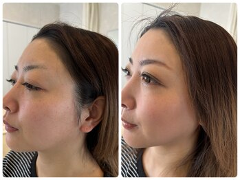 アンベリール(EMBELLIR)/ご新規限定フェイシャルプラン