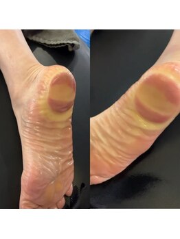 サロン マイワン(Salon MyONE)/足裏の筋膜ケア反応