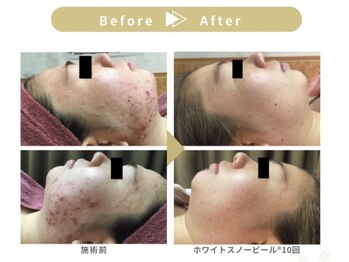 アイル そよら海老江店/ホワイトスノーピール結果