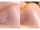 メイヴィ 四日市(Maivi)の写真/【毛穴＆エイジングのWケア◎】最新型の毛穴洗浄×お悩みに合わせたケアで長年の毛穴コンプレックス解消♪