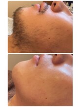 ソワイユ 浜松店(Soyeux)/ワックス脱毛（メンズおひげ）