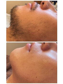 ソワイユ 浜松店(Soyeux)/ワックス脱毛(メンズおひげ)