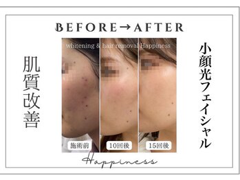 ハピネス 大阪梅田店(Happiness)/小顔光フェイシャル