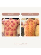 ウルル 福岡(Uluru)/赤く残るカッピングの跡