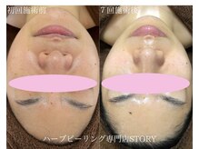 ストーリー 沼津店(STORY)の雰囲気（ハーブピーリングむくみ改善も◎ニキビケア/シミシワたるみ/毛穴）