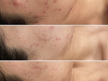 トータルビューティ リライフ(Total beauty Relife)/ハーブセラムとエンザイム