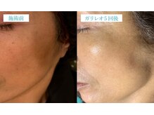 マリーボーテ 名古屋店/【ピーリング５回】シミが改善