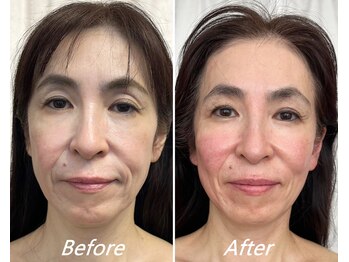 ドクターボディ 新宿店(Dr.Body)/【目元たるみ/歪み/左右差50代】