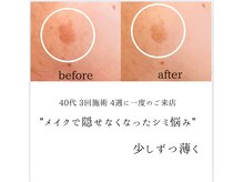 シミリセット 名駅(シミReset)/諦めかけたシミ・改善