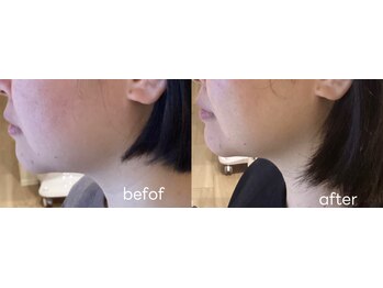 レアビューティー(Le'a beauty)/レモンボトル6回