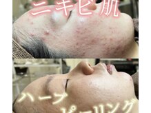 ウィズサロン 天神大名店(withサロン)の雰囲気（ハーブピーリング）