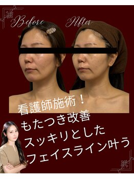 リノン(LIINON)/もたつき改善!!