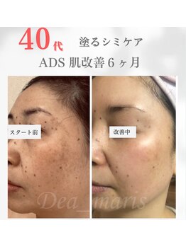 デアマリス/40代 後半 ホームケアで肌改善