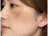 【ダウンタイム軽減】内出血/赤み◆術後の肌ダメージ修復