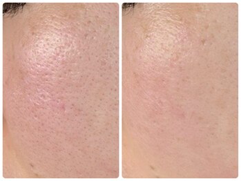 ローマサロン/白玉スノーピールトリートメント