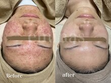 エミナス(EMINAS)/ニキビ改善