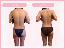 RHB 横浜店/【痩身コース】ビフォーアフター