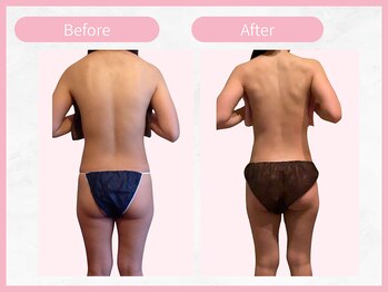 RHB 横浜店/【痩身コース】ビフォーアフター