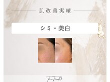 スリースリー 恵比寿(THREE THREE)/シミ・美白ケア 改善実績写真