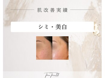 スリースリー 恵比寿(THREE THREE)/シミ・美白ケア 改善実績写真