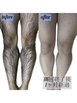 ぺルラ 島田駅前店(Perla)/メンズ膝上下 before→after