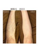 ココ(Coco)/メンズ脱毛　足