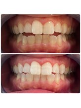 ユーラボ 表参道(YOU-LAB)/Befor/After【ホワイトニング】