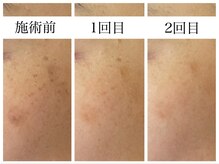 アリエス/ハイドラ×美白フォト