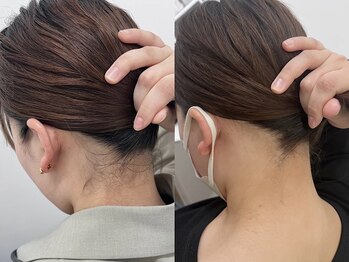 ミース 福岡本店/うなじ矯正◆ビフォーアフター