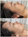 キキ(KiKi)&nbsp;フェイスラインのたるみを引締め★痩せ見え効果も◎