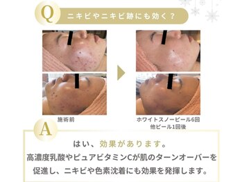 アイル そよら海老江店/ホワイトスノーピール結果