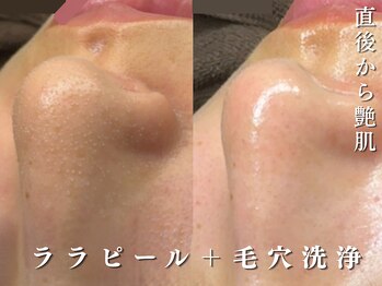 ダリア(Dahlia)/ハーブピーリング+毛穴洗浄