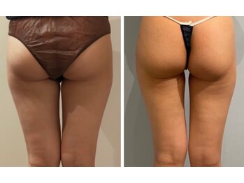 エイシスグロウ(asis glow.)/効果写真